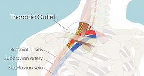 Transaxillary First Rib Resection for Thoracic Outlet Syndrome (TOS)