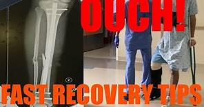 How to Recover Quickly From Broken Leg (Fractured Tibia + Fibula, ORIF Surgery)