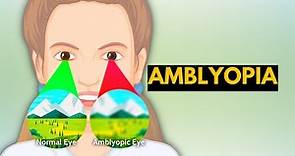 Amblyopia, Causes, Signs and Symptoms, Diagnosis and Treatment.