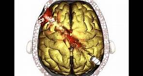 Brain Injury - Gunshot