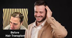 Rob Share His Hair Transplant Experience By Dr Mark Tam, Frontal Area