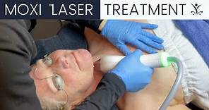 What is a Moxi Laser Treatment?