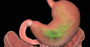 Stomach Ulcer | Nucleus Health