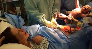 Incredible video of woman giving birth through natural caesarean