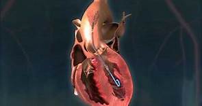 Impella CP® Heart Pump Animation