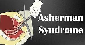 Asherman Syndrome - Causes, Signs & Symptoms, Diagnosis & Treatment