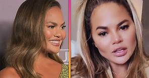 Chrissy Teigen Reveals Cosmetic Surgery on Her Face