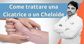 Come trattare una cicatrice cheloide