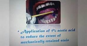 Toluidin Blue staining procedure for early detection of oral cancerous lesion