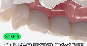 Beame 自有光口腔（深圳） - 【植牙 5 步曲】自有光微創植牙療程輕鬆簡單，療程價格僅市面 1/3。每顆牙僅...