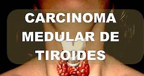 Carcinoma Medular de Tiroides. Explicación completa