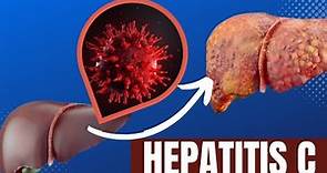 ¿Qué es la Hepatitis C?