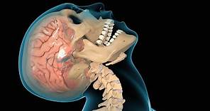 Concussion / Traumatic Brain Injury (TBI)