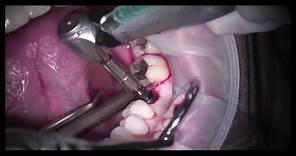 Guided Dental Implant Surgery: Part 2