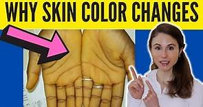 WHY YOUR SKIN COLOR CHANGES | Dermatologist @DrDrayzday