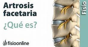 Artrosis facetaria vertebral - ¿Qué es?