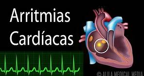 Arritmias Cardíacas, Animación. Alila Medical Media Español.