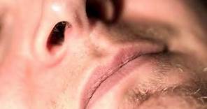 Pólipos nasales (masas o bolitas en la nariz): qué son, síntomas y tratamiento.