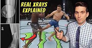 Chris Weidman Shares REAL Xrays of Broken Leg from UFC 261 - Doctor Explains Images