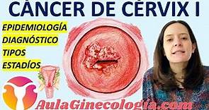 🦀 CÁNCER DE CUELLO DE ÚTERO I: 🌍 TIPOS, 🩺 DIAGNÓSTICO, 🤒 ESTADIAJE... - Ginecología y Obstetricia -