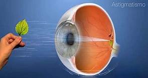 ¿Qué es el astigmatismo? ¿Cómo ve un astigmático?
