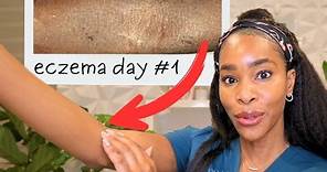 12 Life Changing Tips For Eczema: From a Derm with Eczema