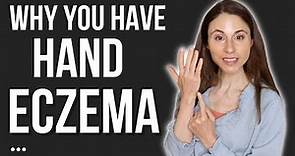 THIS IS WHY YOU HAVE HAND ECZEMA 🖐 DERMATOLOGIST @DrDrayzday