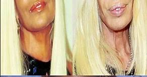 Donatella Versace before and after plastic surgery #shorts