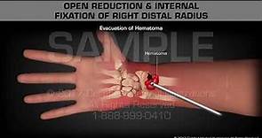 Open Reduction & Internal Fixation of Right Distal Radius