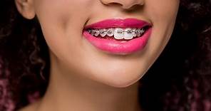 Dental Insurance for Braces: The Best Orthodontic Coverage - Dentaly.org