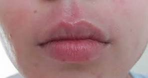 How to get rid of Perioral Dermatitis