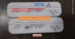 Scrub typhus antibody test positive Introduction, principle, procedure and result interpretation