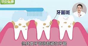 牙齦不舒服可能是牙菌斑惹的禍！ 醫師教你怎麼做好口腔護理