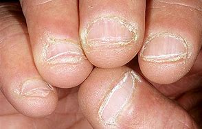 Obraz znaleziony dla: obgryzanie paznokci