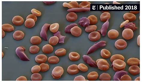 How One Child’s Sickle Cell Mutation Helped Protect the World From