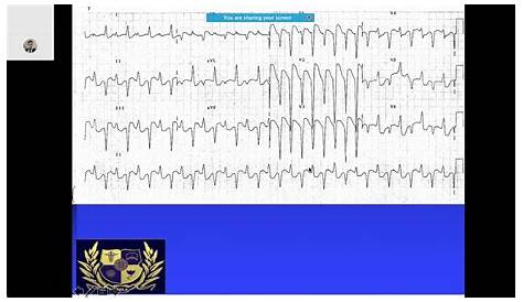 #ECG #Quiz with explanation and answers 2 #ecgforcardiologist #