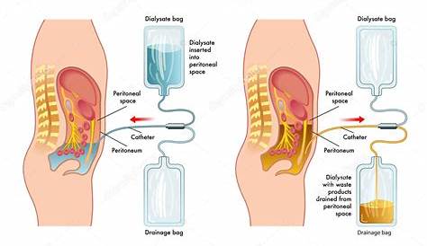 manual peritoneal dialysis steps