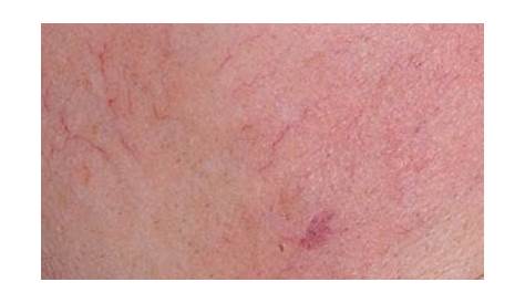 vascular skin lesions dermatology