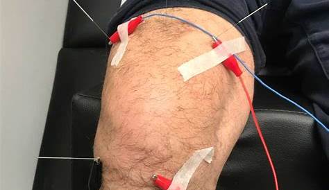 Acupuncture in Tampa, FL for Knee Pain
