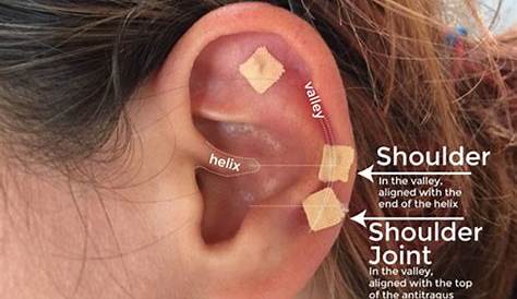 ear seed placement for migraines