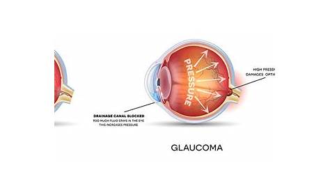 eye pressure chart for glaucoma
