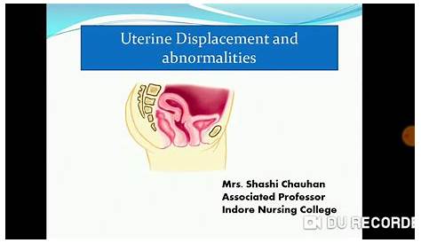 manual lateral uterine displacement