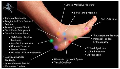 Foot Pain Chart: Top of Foot, Side and Front of Foot Pain Chart
