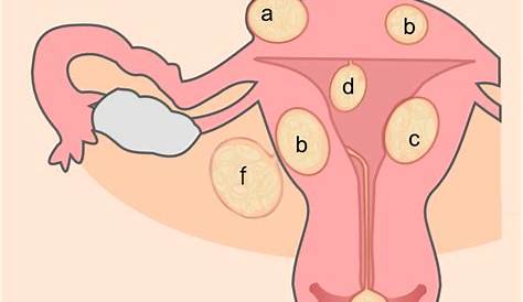 6 Types of Uterine Fibroids and Symptoms Explained - YouMeMindBody
