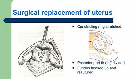 manual replacement of uterus