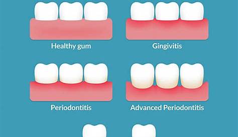 Gum Disease - Camden Hills Dental Care