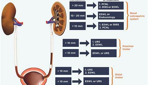 Which Kidney Stone Treatment Method is Right for Me? — Dornier MedTech
