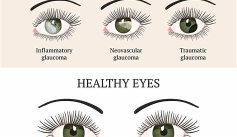 Natural Ways to Lower Eye Pressure