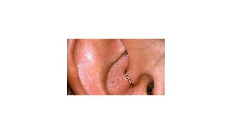 Could I lose weight by getting my ear stapled? | Acupressure, EFT