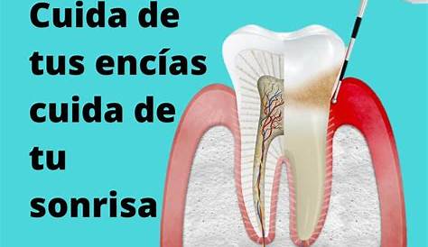 ️¿Cómo se cura la gingivitis? - Clínica Dental Tacna